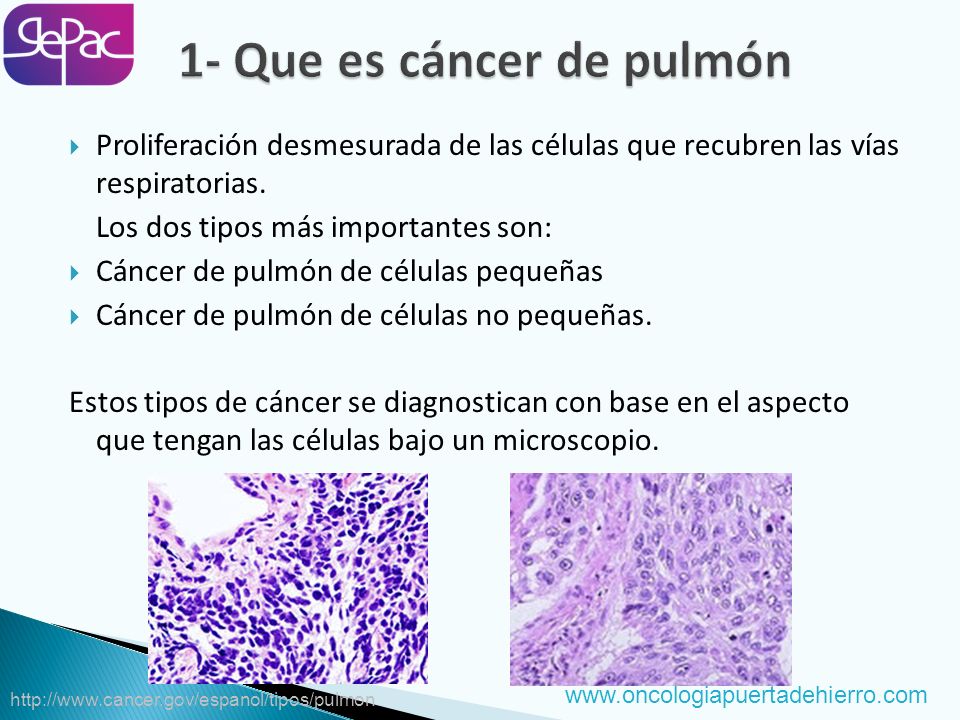 Video de adenocarcinoma de próstata de células pequeñas puro